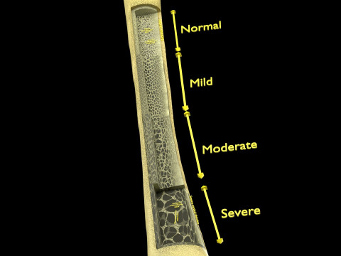 Osteoporosis and its stages Model 3D