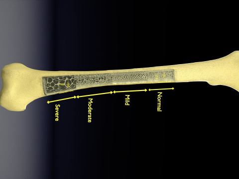 Osteoporosis and its stages Model 3D