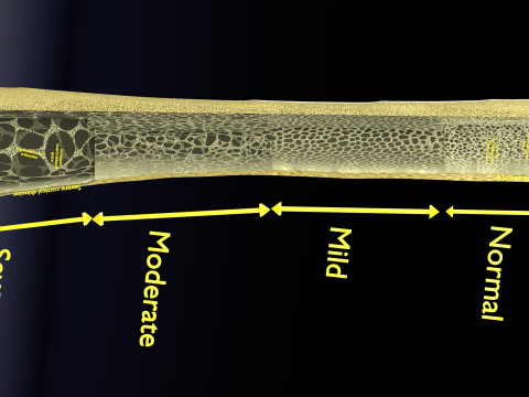 Osteoporosis and its stages Model 3D