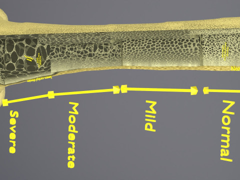 Osteoporosis and its stages Model 3D