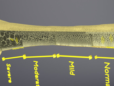 Osteoporosis and its stages Model 3D