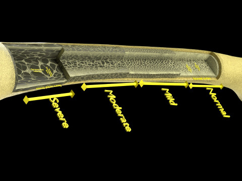 Osteoporosis and its stages Model 3D