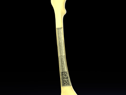 Osteoporosis and its stages Model 3D