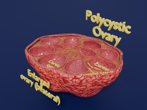 Polycystic Ovary Disease PCOD 3D Model