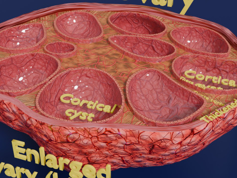 Polycystic Ovary Disease PCOD 3D 모델