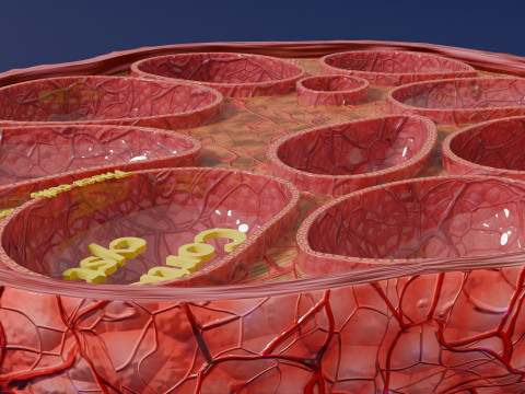 Polycystic Ovary Disease PCOD 3D 모델