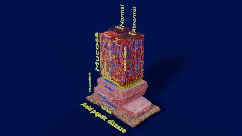 Stomach Gastric acid peptic disease ulcer Model 3D .c4d .max .obj .3ds .fbx .stl .blend