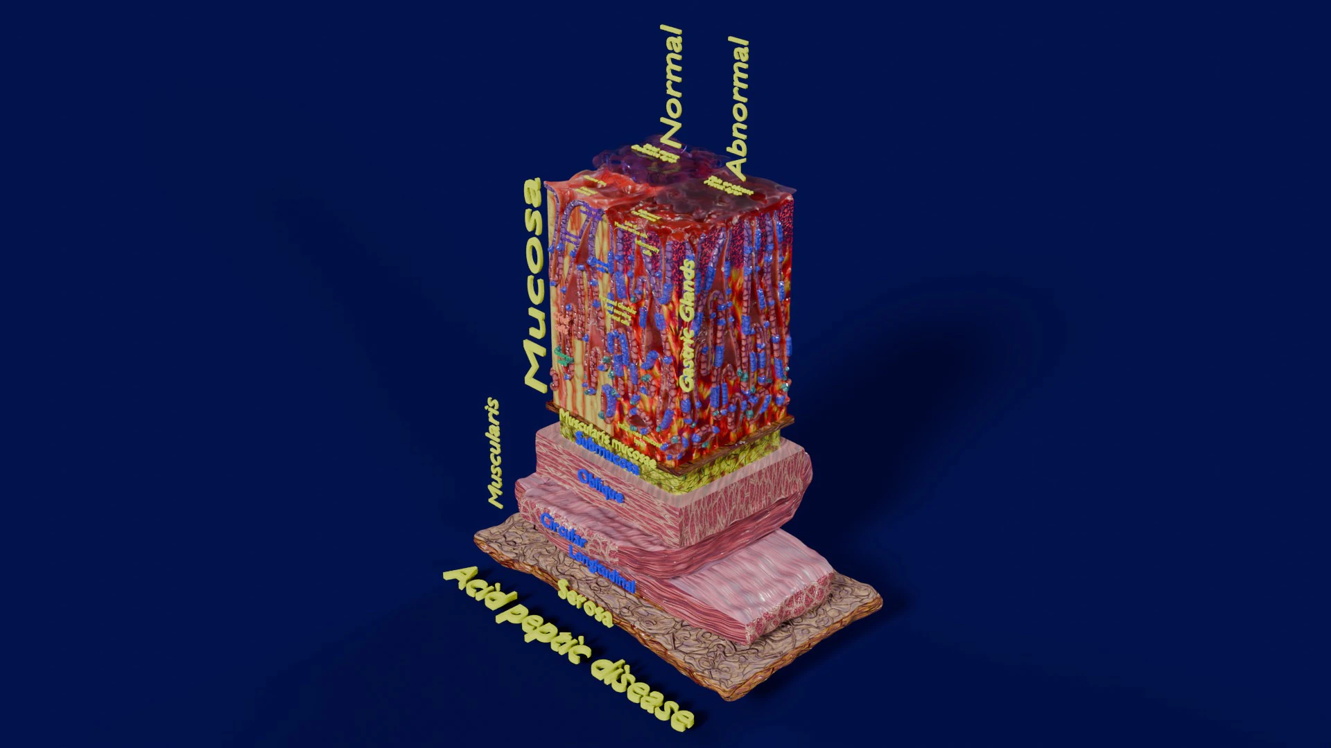 Stomach Gastric acid peptic disease ulcer 3D Model .c4d .max .obj .3ds .fbx .stl .blend 