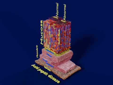 Stomach Gastric acid peptic disease ulcer 3D Model
