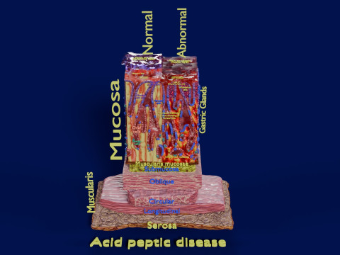 Stomach Gastric acid peptic disease ulcer Model 3D