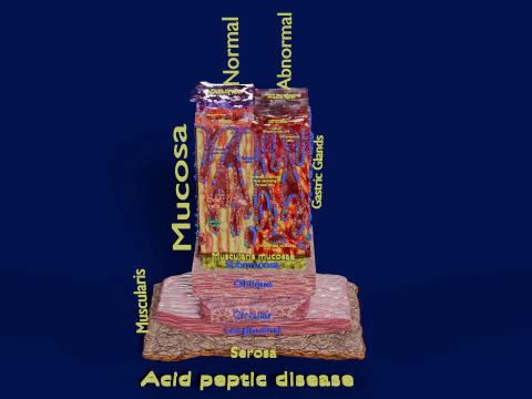 Stomach Gastric acid peptic disease ulcer 3D Model