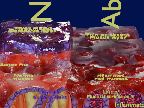 Stomach Gastric acid peptic disease ulcer Model 3D