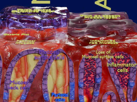 Stomach Gastric acid peptic disease ulcer 3D Model