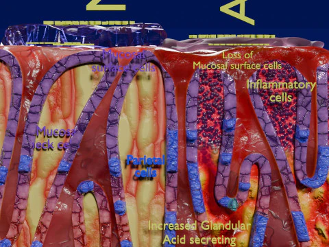 Stomach Gastric acid peptic disease ulcer 3D Model