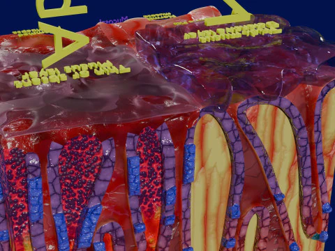 Stomach Gastric acid peptic disease ulcer 3D Model
