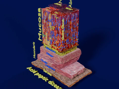Stomach Gastric acid peptic disease ulcer 3D Model