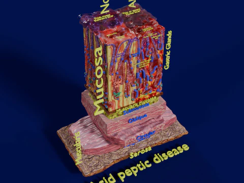 Stomach Gastric acid peptic disease ulcer 3D Model