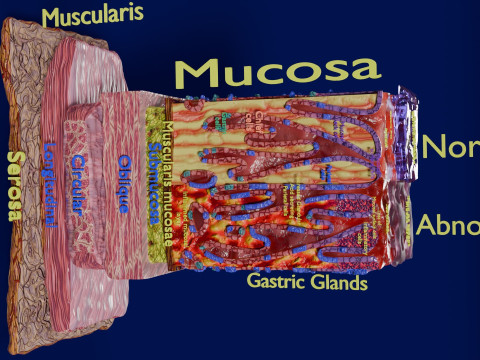 Stomach Gastric acid peptic disease ulcer Model 3D