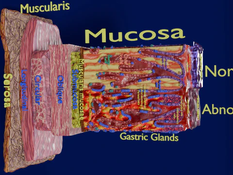 Stomach Gastric acid peptic disease ulcer 3D Model
