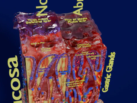 Stomach Gastric acid peptic disease ulcer 3D Model
