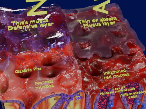 Stomach Gastric acid peptic disease ulcer 3D Model