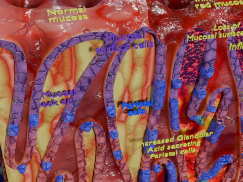 Stomach Gastric acid peptic disease ulcer 3D Model