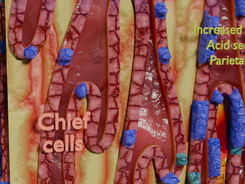 Stomach Gastric acid peptic disease ulcer 3D Model