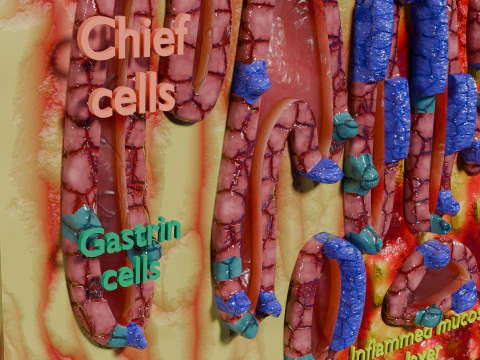 Stomach Gastric acid peptic disease ulcer 3D Model