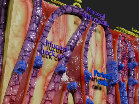 Stomach Gastric acid peptic disease ulcer 3D Model