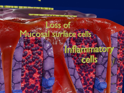 Stomach Gastric acid peptic disease ulcer Model 3D