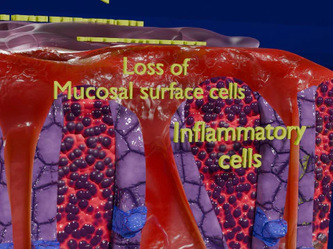 Stomach Gastric acid peptic disease ulcer 3D Model
