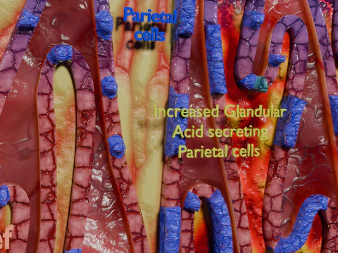 Stomach Gastric acid peptic disease ulcer 3D Model