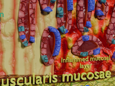 Stomach Gastric acid peptic disease ulcer Model 3D