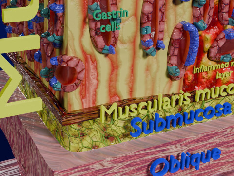 Stomach Gastric acid peptic disease ulcer Model 3D