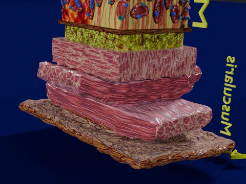 Stomach Gastric acid peptic disease ulcer 3D Model