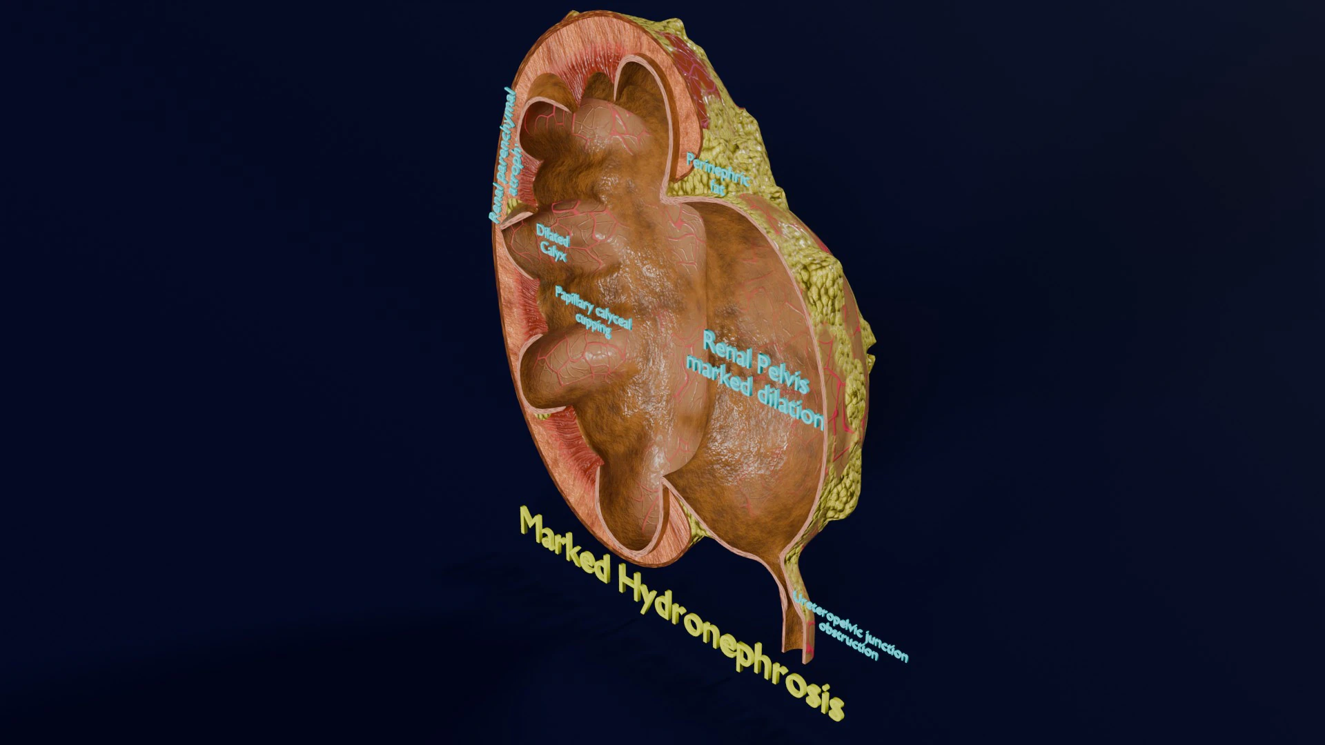 Hydronephrosis marked kidney renal 3D Model .c4d .max .obj .3ds .fbx .stl .blend