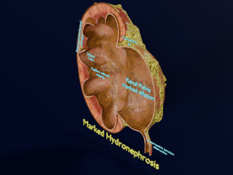 Hydronephrosis marked kidney renal 3D Model