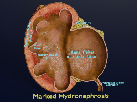 Hydronephrosis marked kidney renal Model 3D