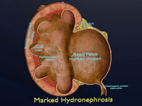 Hydronephrosis marked kidney renal 3D Model