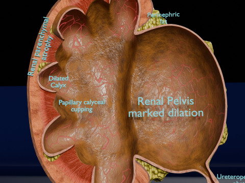 Hydronephrosis marked kidney renal Model 3D