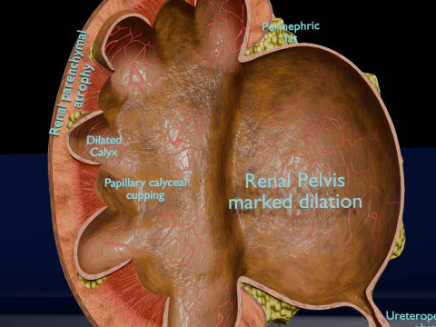 Hydronephrosis marked kidney renal 3D Model