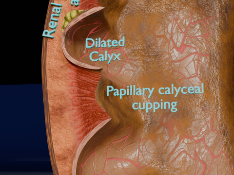 Hydronephrosis marked kidney renal Model 3D
