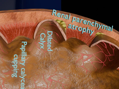 Hydronephrosis marked kidney renal 3D Model