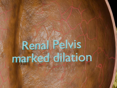 Hydronephrosis marked kidney renal Model 3D
