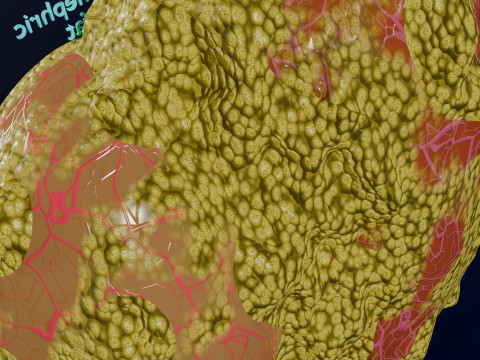 Hydronephrosis marked kidney renal Model 3D
