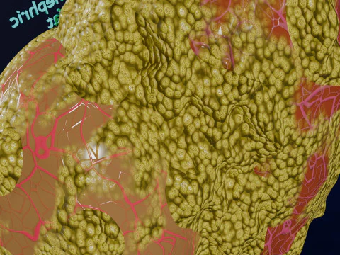 Hydronephrosis marked kidney renal 3D Model