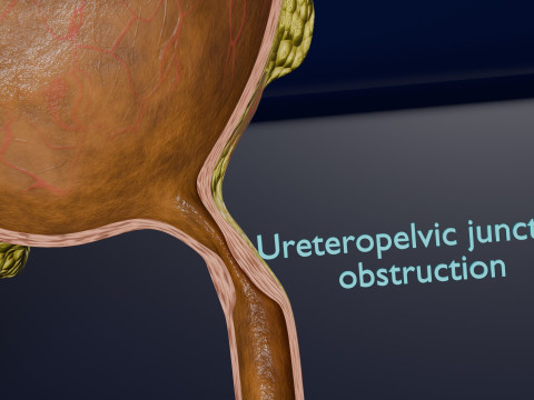 Hydronephrosis marked kidney renal Model 3D