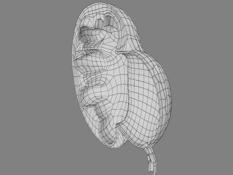 Hydronephrosis marked kidney renal Model 3D