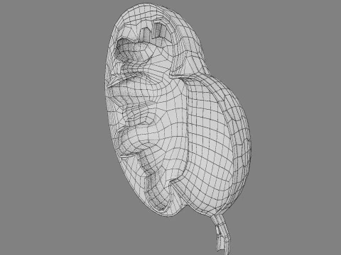 Hydronephrosis marked kidney renal 3D Model