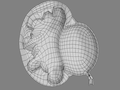 Hydronephrosis marked kidney renal Model 3D